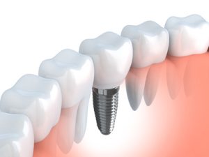 Dental implant