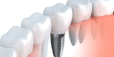 Dental implant